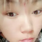 揪痧治咽炎的主播照片